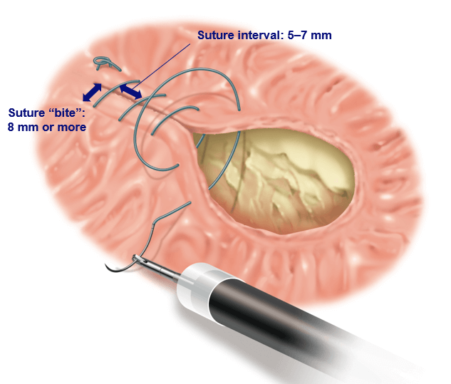 Rhinoplasty Procedure