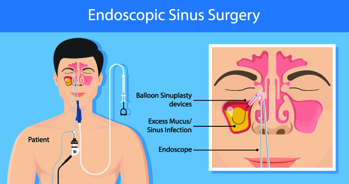 Surgery Procedure